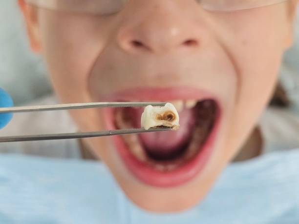 Best Emergency Dental Extractions in Ladonia, AL
